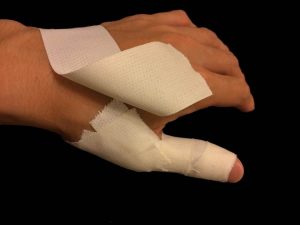 母指MPのテーピング