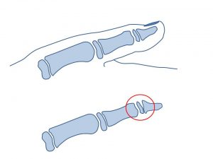 子供の親指の損傷 (3)