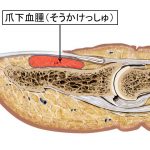 爪下血腫