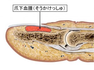 爪下血腫