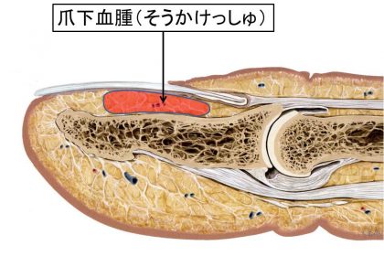 爪下血腫