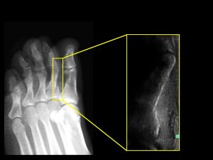 足趾の骨折のレントゲンとエコー像との比較