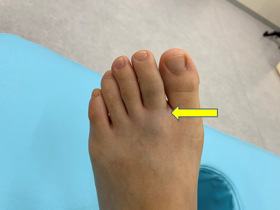 骨折 付け根 足 指 突き指と骨折の見分け方。症状にどんな違いがある？治療法や期間は？
