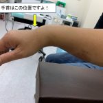 徒手整復で完治した手首の骨折症例　～日曜日の急患（掌側バートン骨折）～