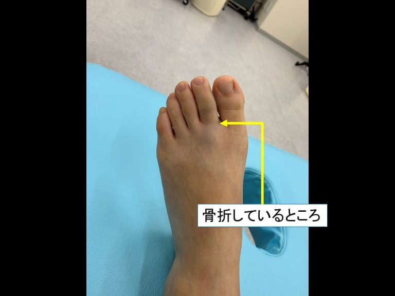 夜間に来院された『足の指の骨折』 朝霞台の骨折捻挫は24時間休診対応の渋谷接骨院へ