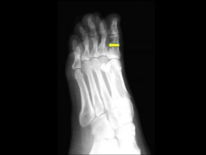 足趾の骨折のレントゲン写真