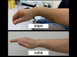 受傷直後と治癒後の手首の外観