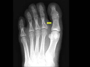 足趾の骨折のレントゲン写真