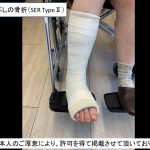 バスケ中の足首の骨折⁉治療上気を付けなければいけないところ（lauge-hansen分類 SER TypeⅡ）