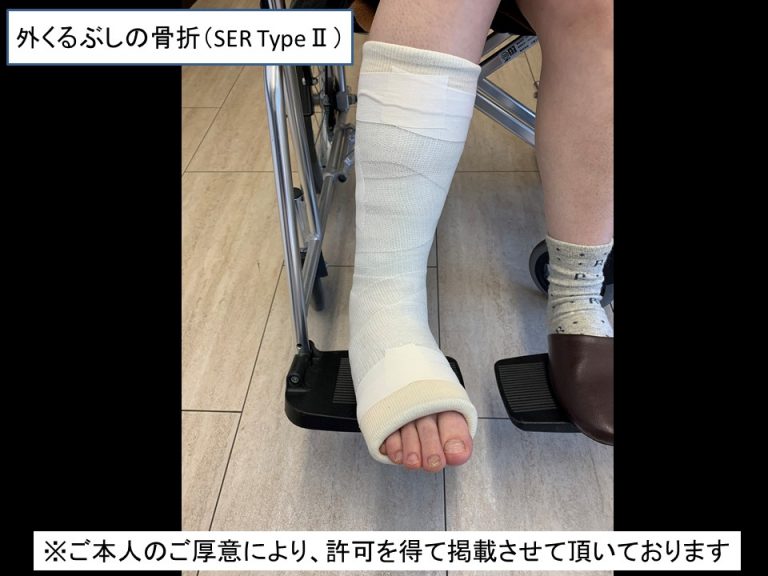 日曜日に来院された『足首の骨折』 朝霞台の骨折捻挫は24時間急患対応の渋谷接骨院へ