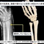 なぜ、固定しても骨折部が痛むのか – 初期処置の重要性
